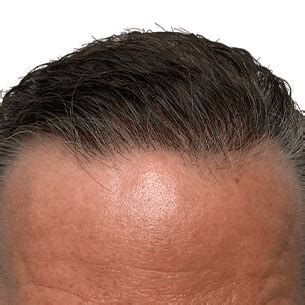 Maxim Hair Restoration .
